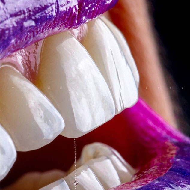 ونیر کامپوزیت و سرامیکی veneer , laminate
