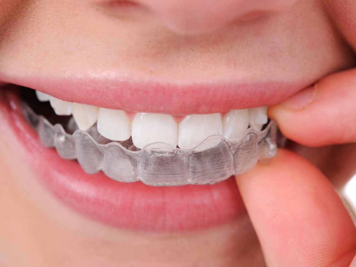 bleaching 6 خانگی سفید کردن زیبایی