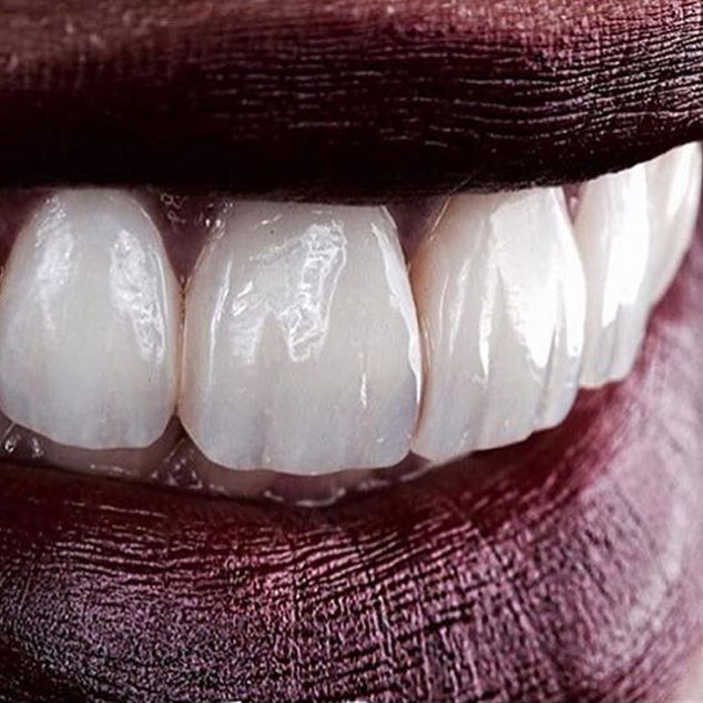 ونیر و لمینت و veneer و پری ناز مهدویان